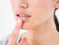 Cara Menyembuhkan Sariawan Paling Efektif